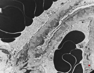  M,59y. | membranous glomerulopathy